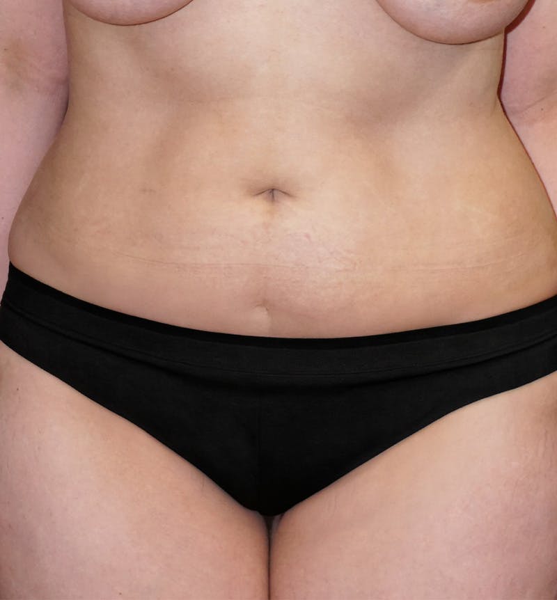Liposuction Before & After Gallery - Patient 238629 - Image 1