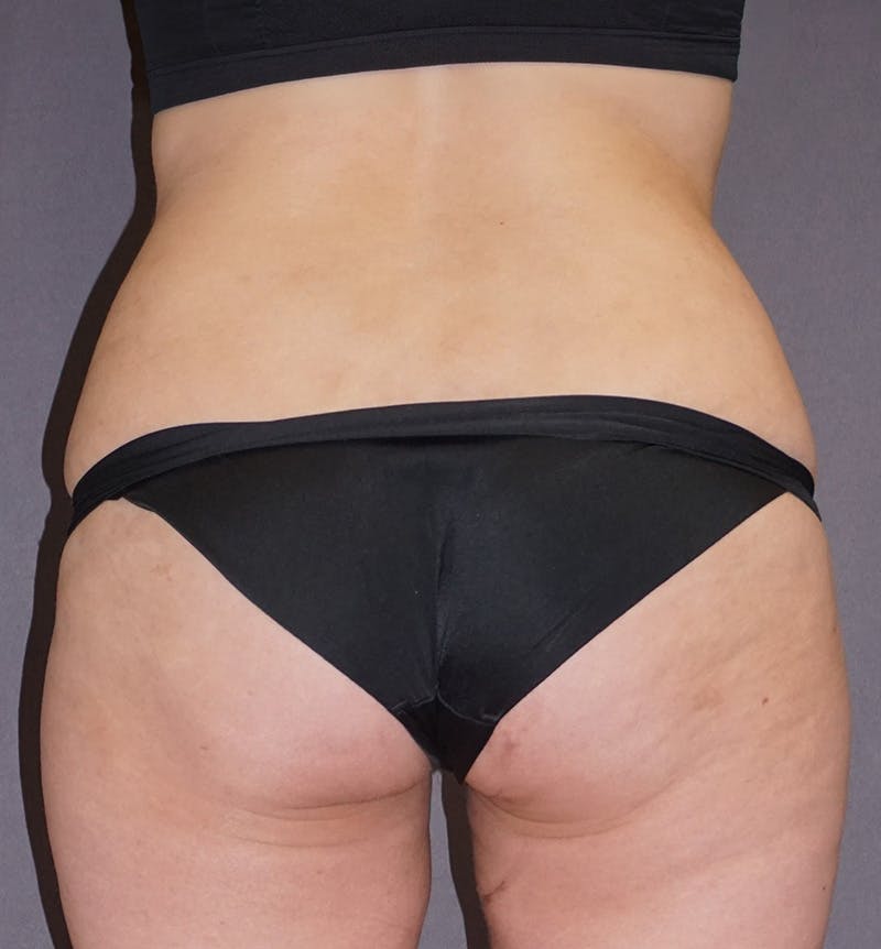 Liposuction Before & After Gallery - Patient 238629 - Image 6