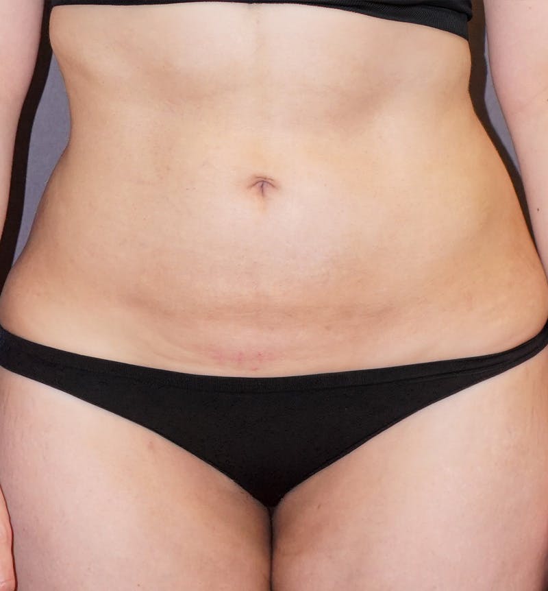 Liposuction Before & After Gallery - Patient 238629 - Image 2