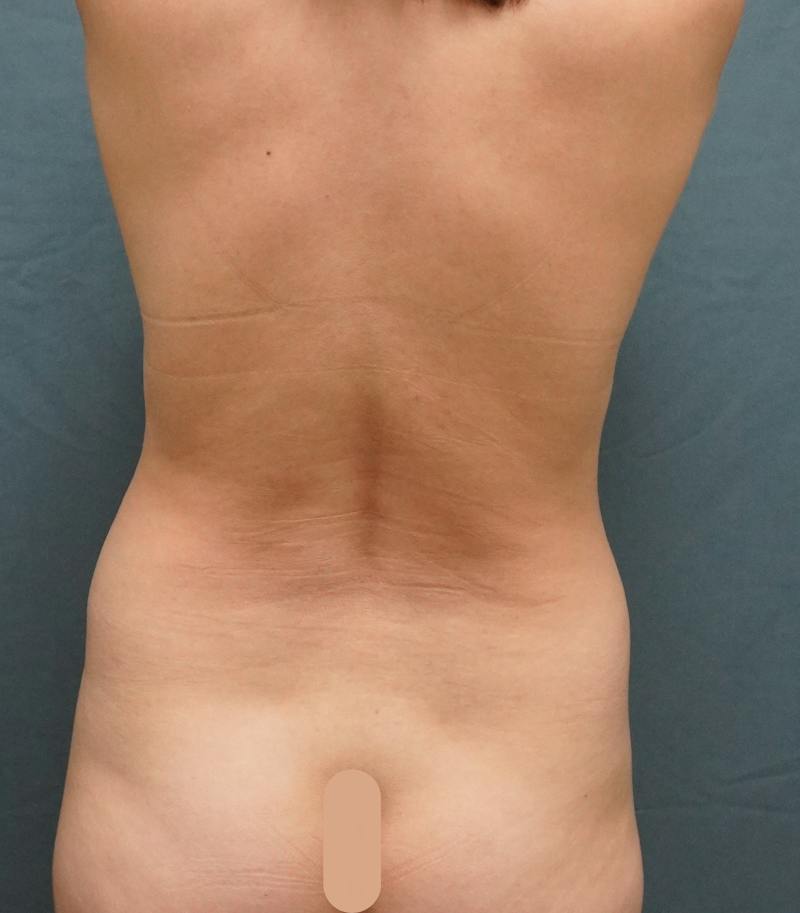 Liposuction Before & After Gallery - Patient 343552 - Image 5