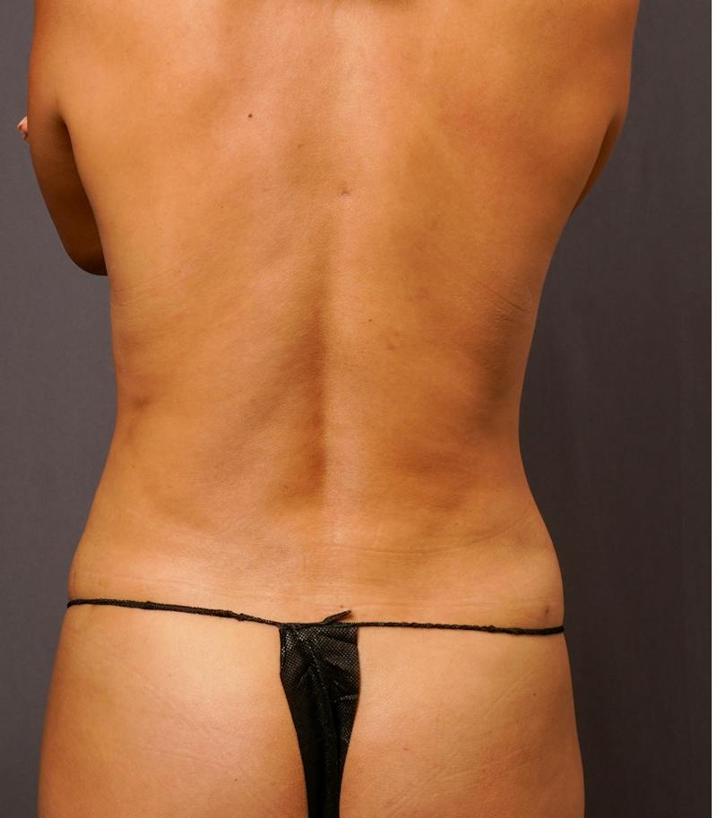 Liposuction Before & After Gallery - Patient 343552 - Image 6
