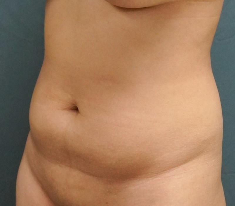 Liposuction Before & After Gallery - Patient 343552 - Image 3