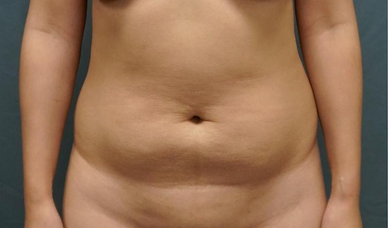 Liposuction Before & After Gallery - Patient 343552 - Image 1