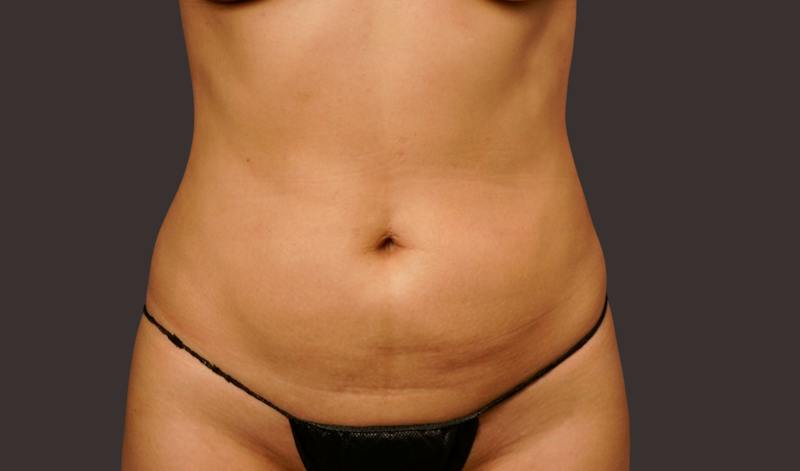 Liposuction Before & After Gallery - Patient 343552 - Image 2