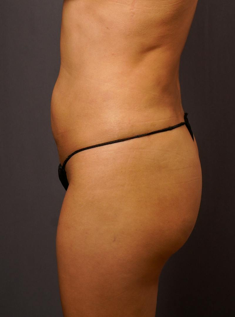 Brazilian Butt Lift Before & After Gallery - Patient 417478 - Image 4