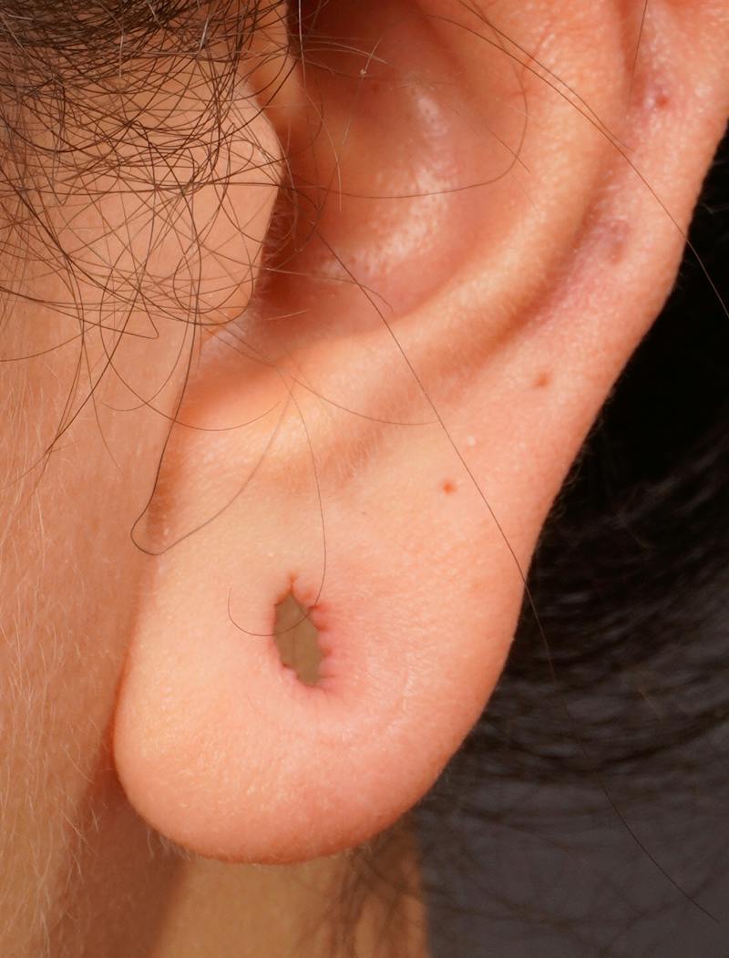 Earlobe Repair Before & After Gallery - Patient 389632 - Image 3