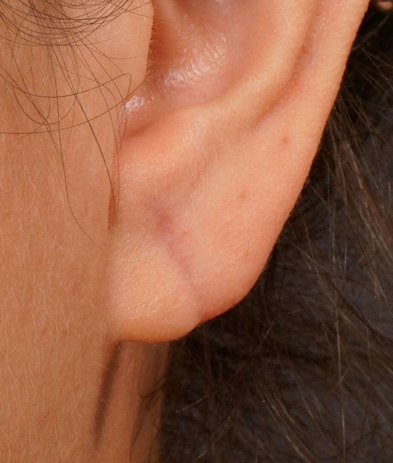 Earlobe Repair Before & After Gallery - Patient 389632 - Image 4