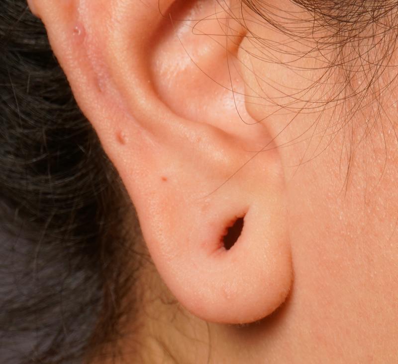 Earlobe Repair Before & After Gallery - Patient 389632 - Image 1