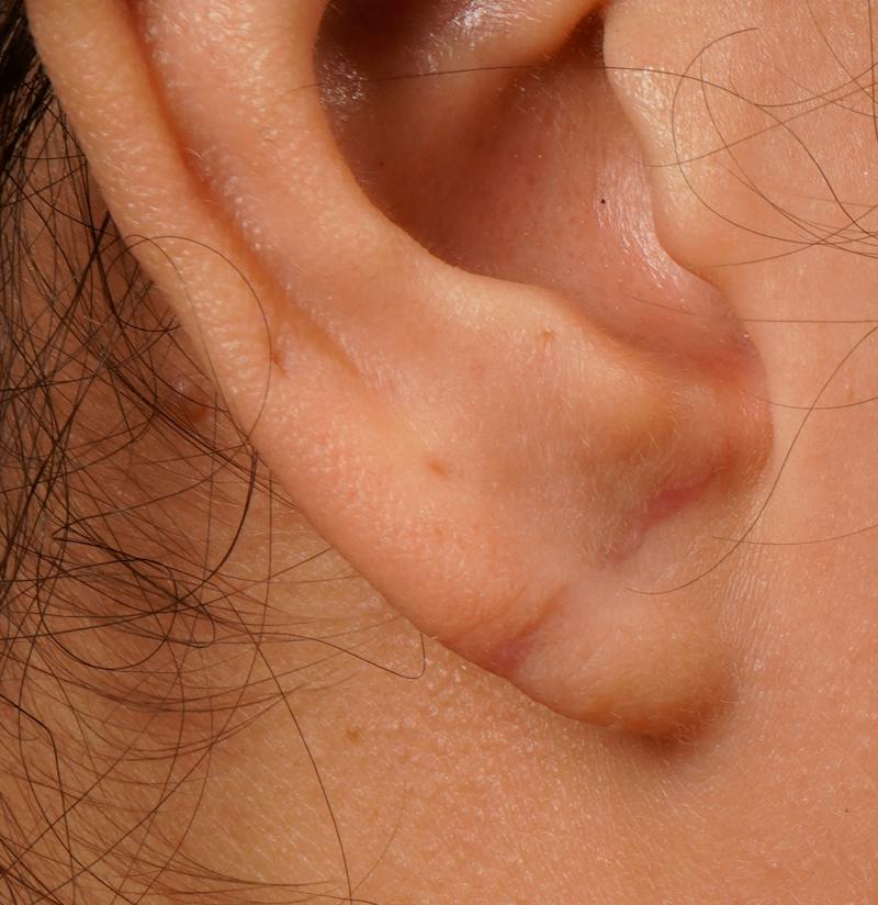 Earlobe Repair Before & After Gallery - Patient 389632 - Image 2