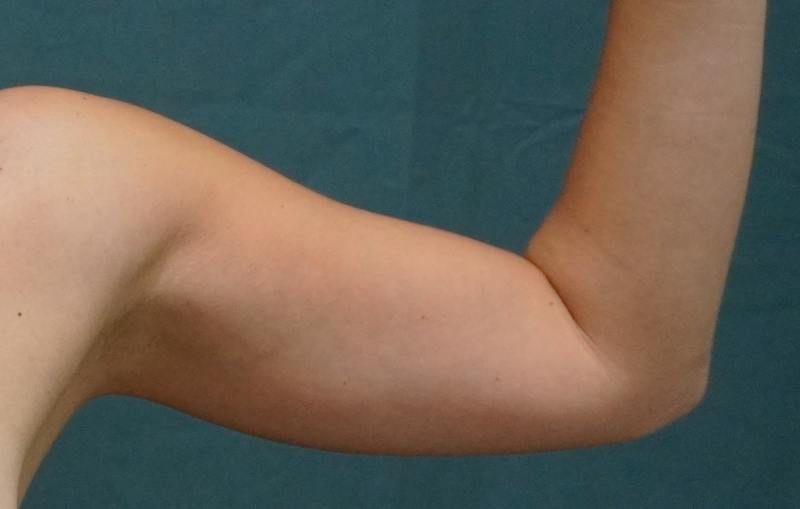 Liposuction Before & After Gallery - Patient 686018 - Image 3
