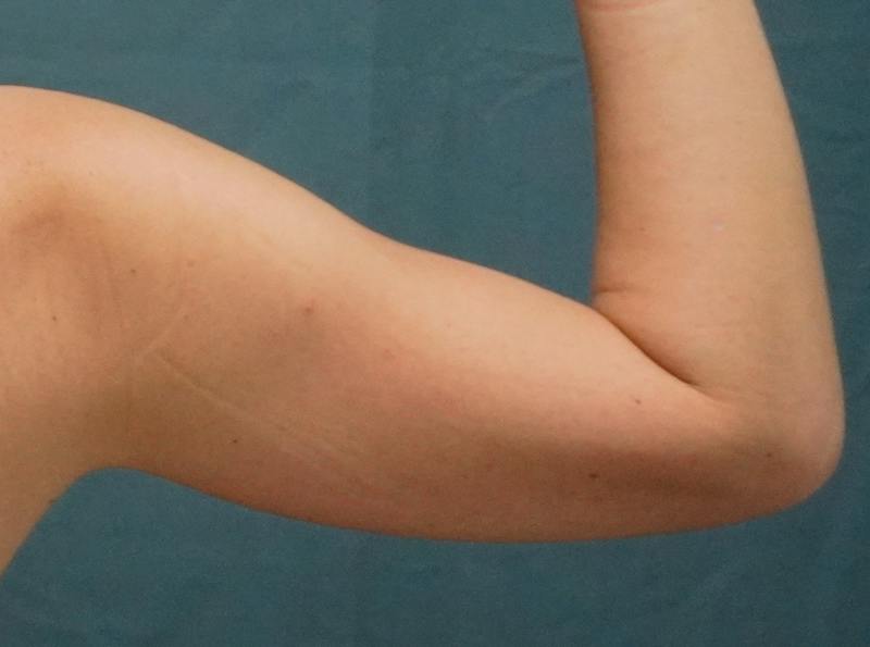 Liposuction Before & After Gallery - Patient 686018 - Image 1