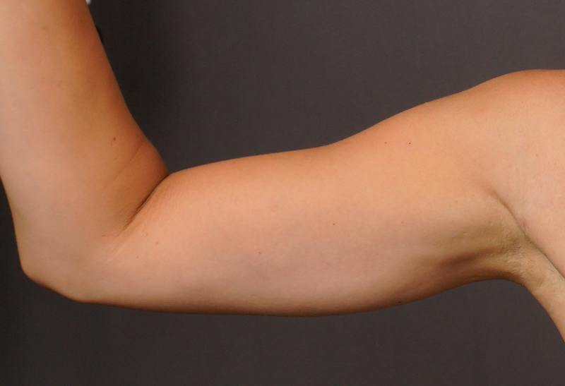 Liposuction Before & After Gallery - Patient 686018 - Image 8
