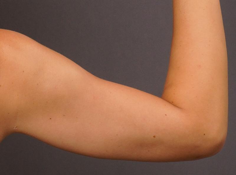 Liposuction Before & After Gallery - Patient 686018 - Image 2