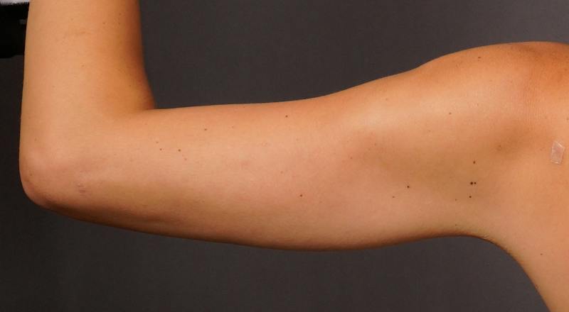 Liposuction Before & After Gallery - Patient 686018 - Image 6