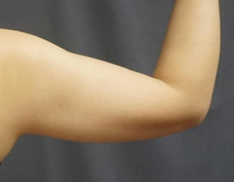 Liposuction Before & After Gallery - Patient 175325 - Image 7