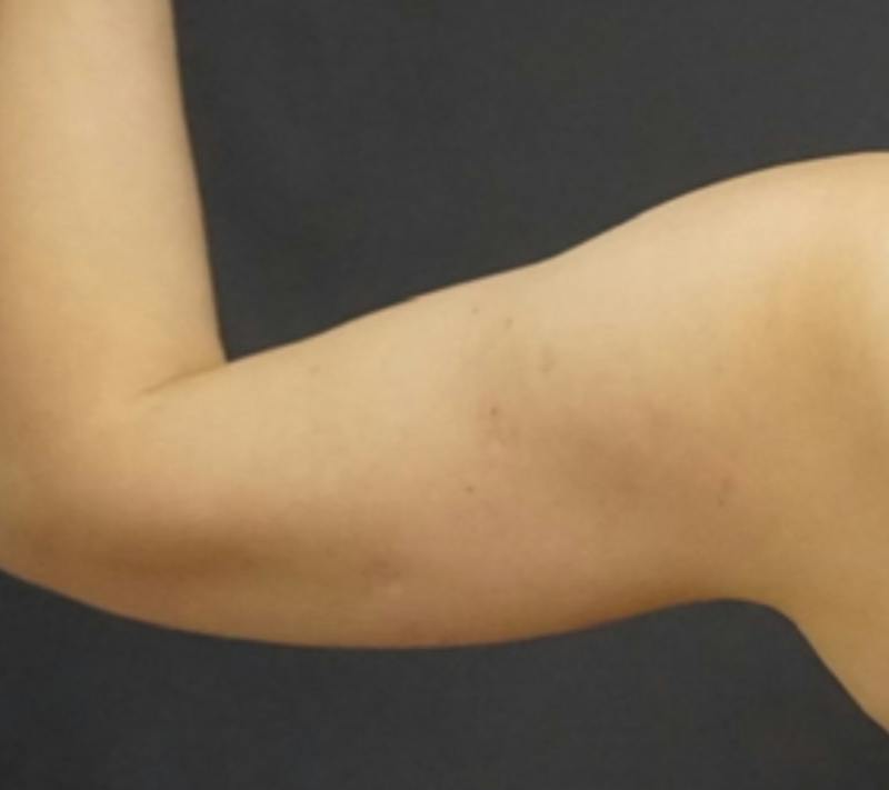 Liposuction Before & After Gallery - Patient 175325 - Image 5