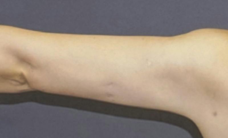 Liposuction Before & After Gallery - Patient 175325 - Image 2