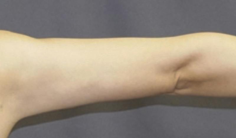 Liposuction Before & After Gallery - Patient 175325 - Image 4
