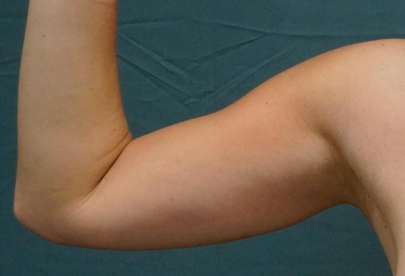 Liposuction Before & After Gallery - Patient 686018 - Image 7
