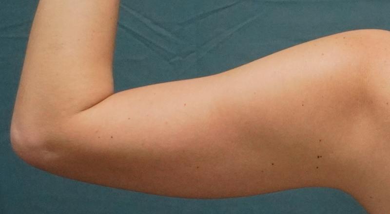 Liposuction Before & After Gallery - Patient 686018 - Image 5
