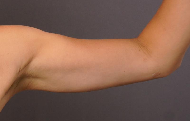 Liposuction Before & After Gallery - Patient 686018 - Image 4