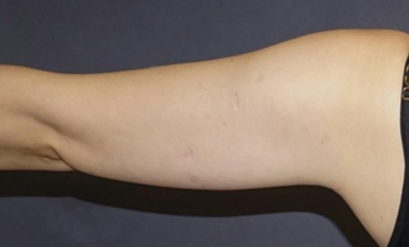 Liposuction Before & After Gallery - Patient 175325 - Image 1