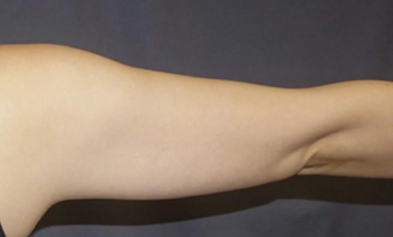 Liposuction Before & After Gallery - Patient 175325 - Image 3
