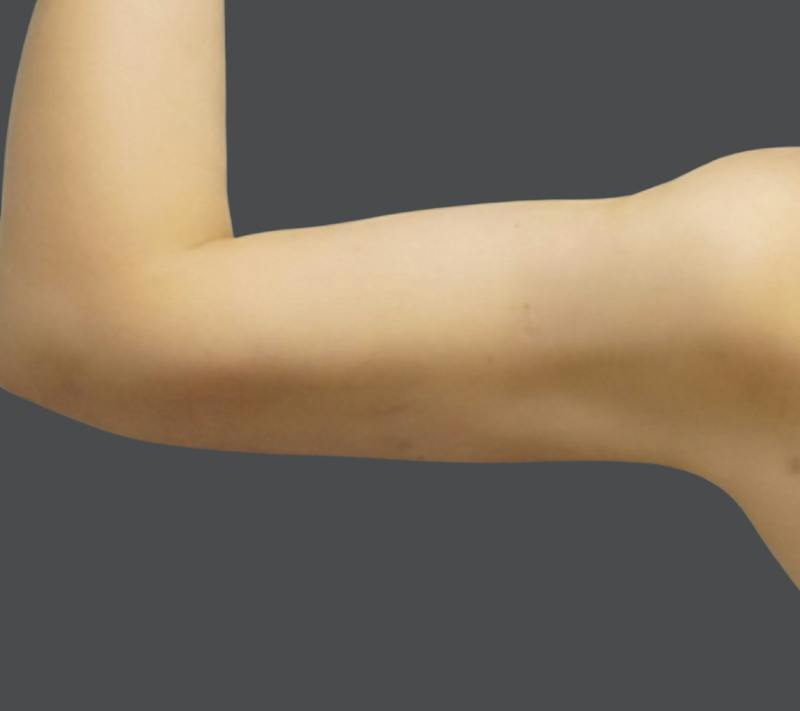 Liposuction Before & After Gallery - Patient 175325 - Image 6