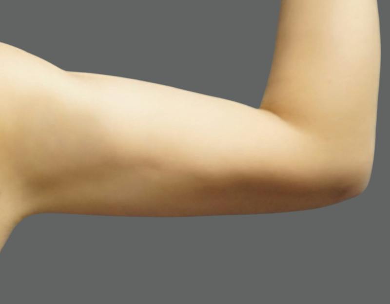 Liposuction Before & After Gallery - Patient 175325 - Image 8