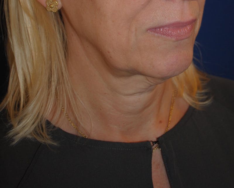 Facelift/Mini Facelift Before & After Gallery - Patient 272316 - Image 3