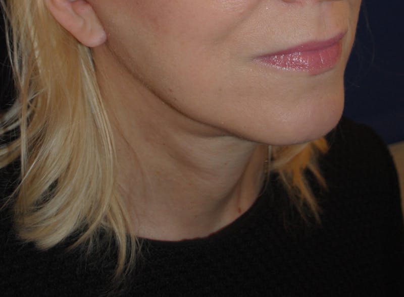 Facelift/Mini Facelift Before & After Gallery - Patient 272316 - Image 4