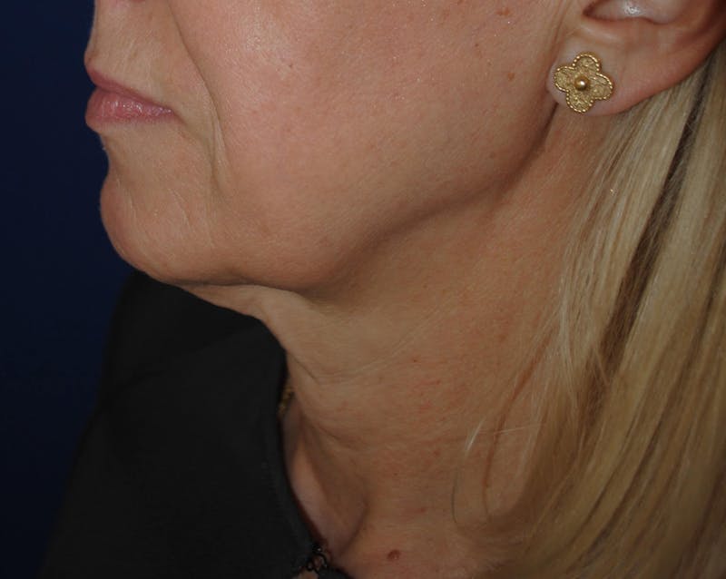 Facelift/Mini Facelift Before & After Gallery - Patient 272316 - Image 5
