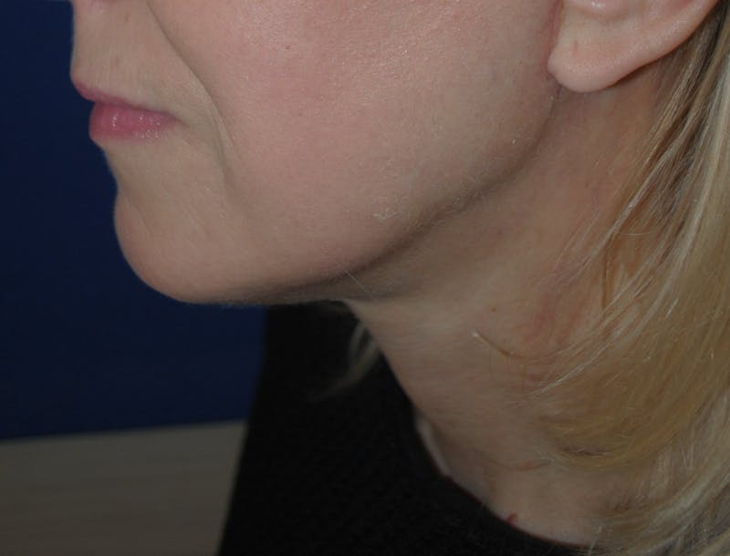 Facelift/Mini Facelift Before & After Gallery - Patient 272316 - Image 6