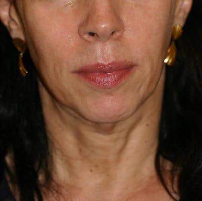 Facelift/Mini Facelift Before & After Gallery - Patient 202070 - Image 1