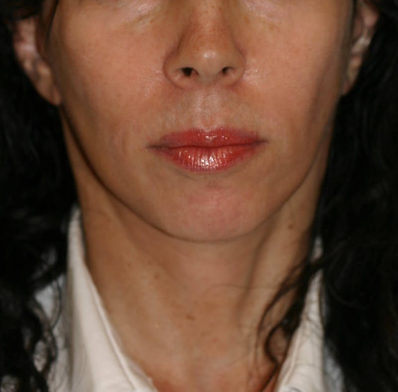 Facelift/Mini Facelift Before & After Gallery - Patient 202070 - Image 2