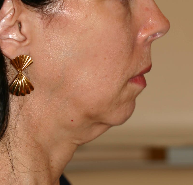 Facelift/Mini Facelift Before & After Gallery - Patient 202070 - Image 3