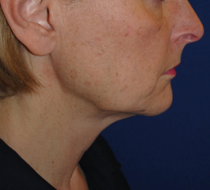 Facelift/Mini Facelift Before & After Gallery - Patient 168974 - Image 3