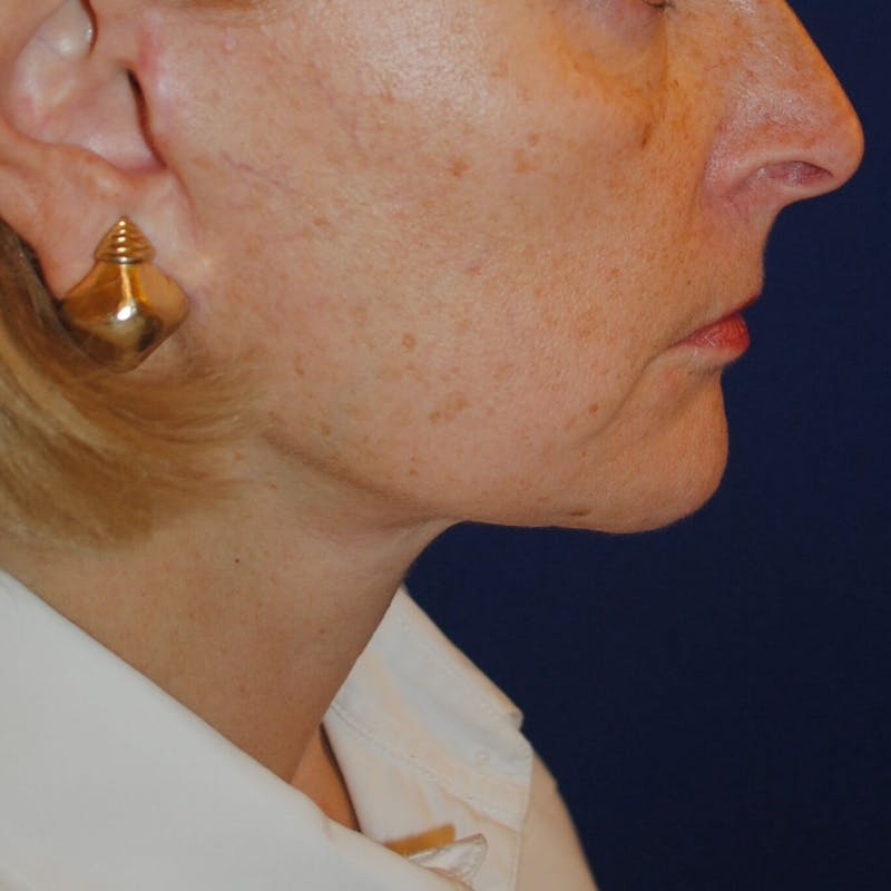 Facelift/Mini Facelift Before & After Gallery - Patient 168974 - Image 4