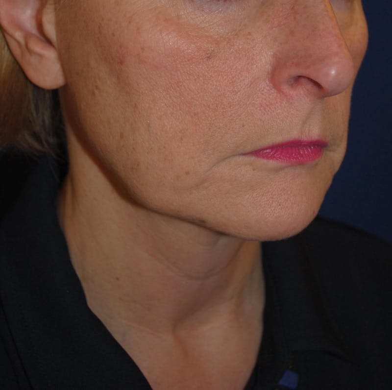 Facelift/Mini Facelift Before & After Gallery - Patient 168974 - Image 5