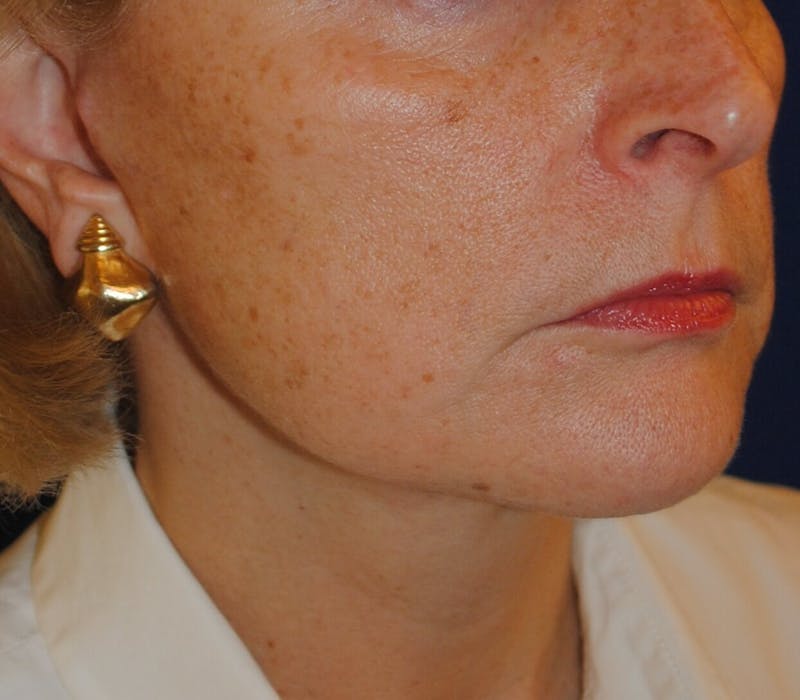 Facelift/Mini Facelift Before & After Gallery - Patient 168974 - Image 6