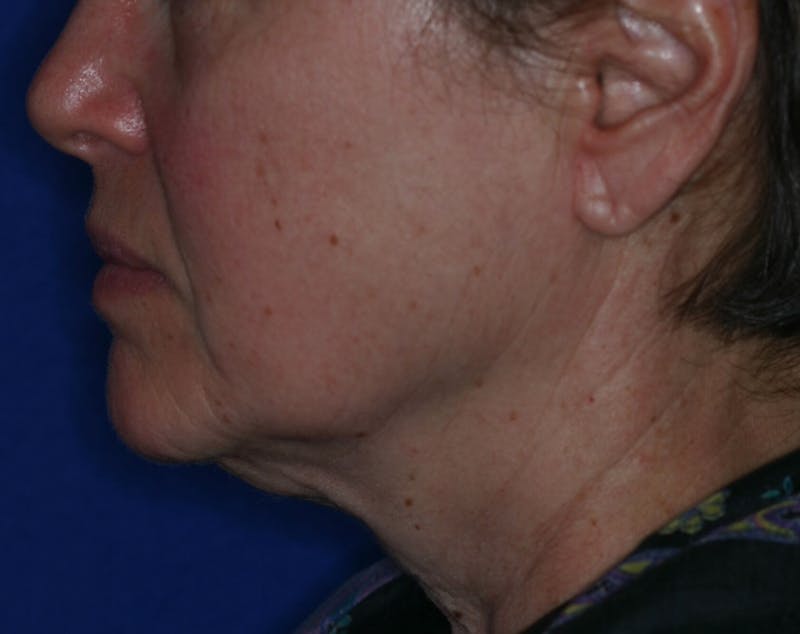Facelift/Mini Facelift Before & After Gallery - Patient 180629 - Image 3