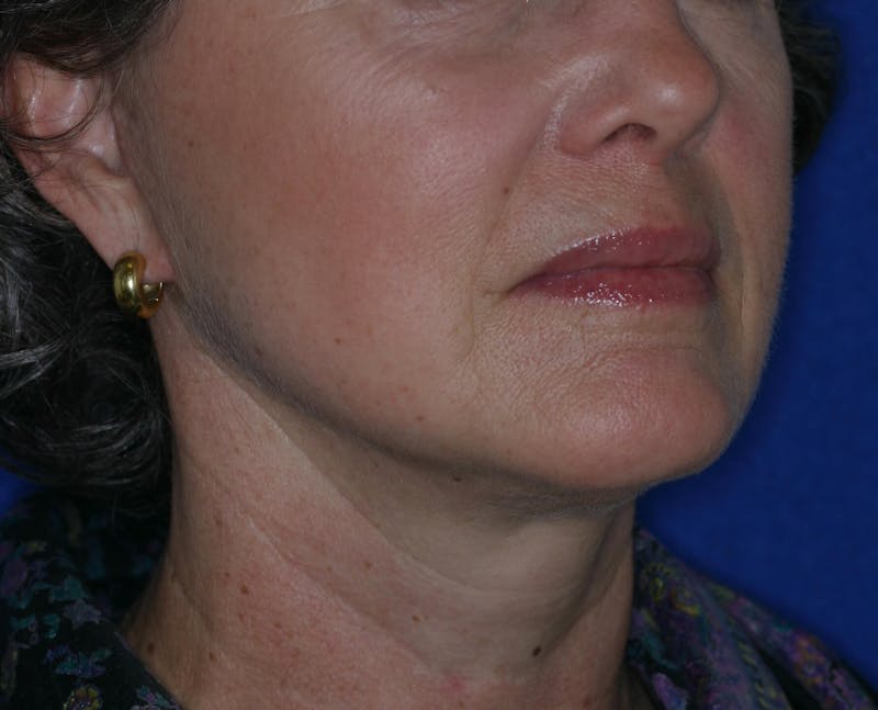 Facelift/Mini Facelift Before & After Gallery - Patient 180629 - Image 6