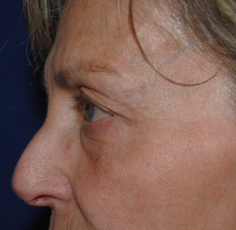 Eyelid Surgery Before & After Gallery - Patient 265850 - Image 1