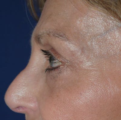 Eyelid Surgery Before & After Gallery - Patient 265850 - Image 2