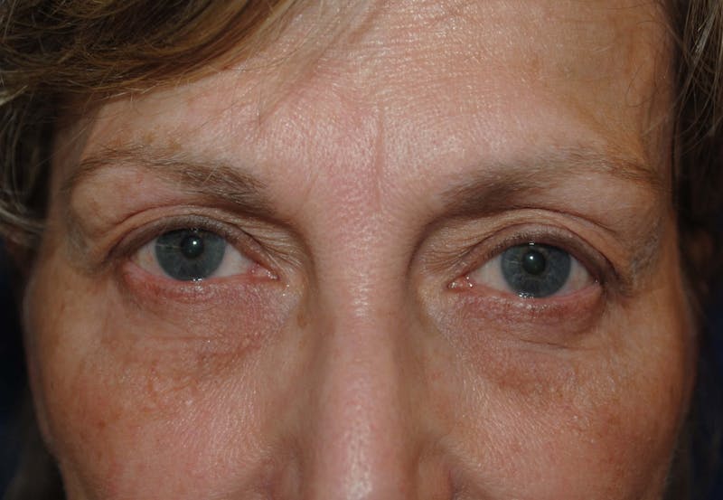 Eyelid Surgery Before & After Gallery - Patient 265850 - Image 3