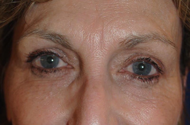 Eyelid Surgery Before & After Gallery - Patient 265850 - Image 4