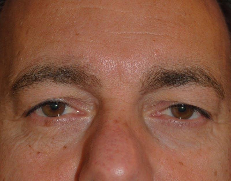 Eyelid Surgery Before & After Gallery - Patient 364560 - Image 1