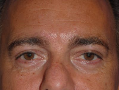 Eyelid Surgery Before & After Gallery - Patient 364560 - Image 2