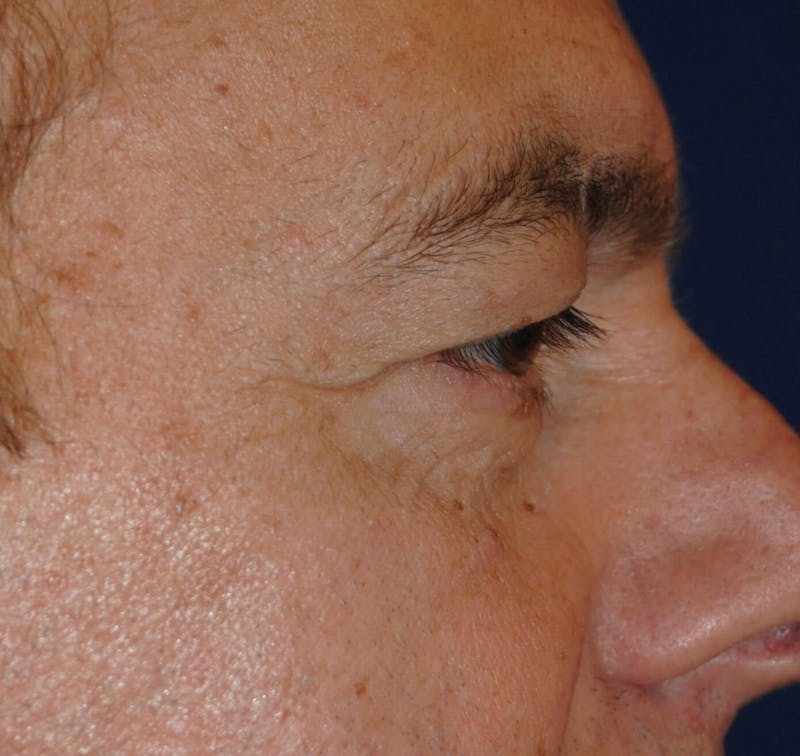 Eyelid Surgery Before & After Gallery - Patient 364560 - Image 3