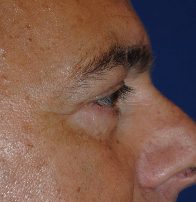 Eyelid Surgery Before & After Gallery - Patient 364560 - Image 4